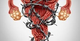 Endometriosis