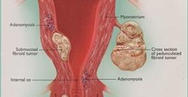 Fibroids