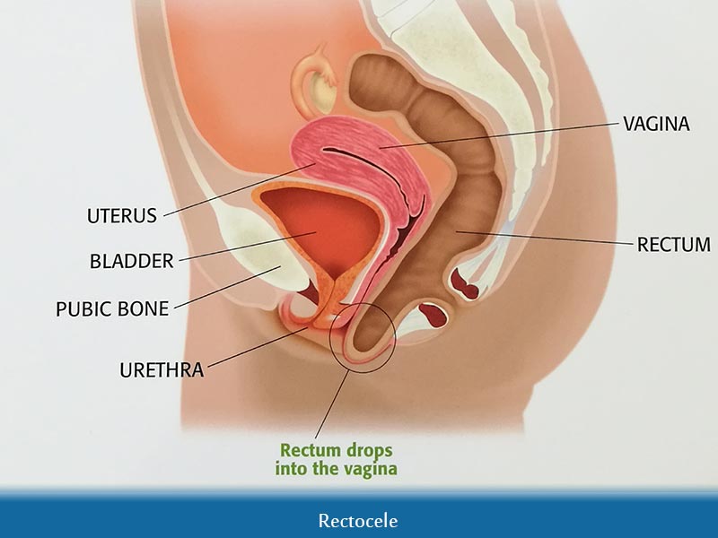 Rectocele