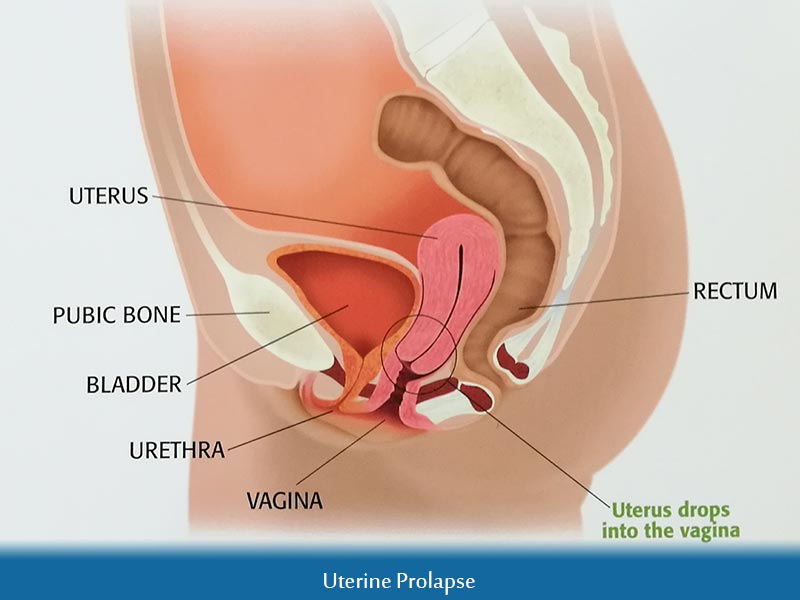 Uterine Prolapse