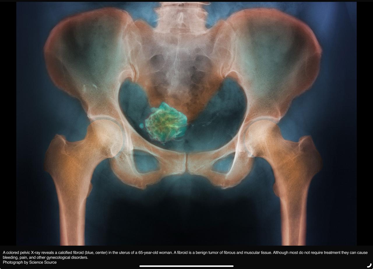 Testing For Fibroids