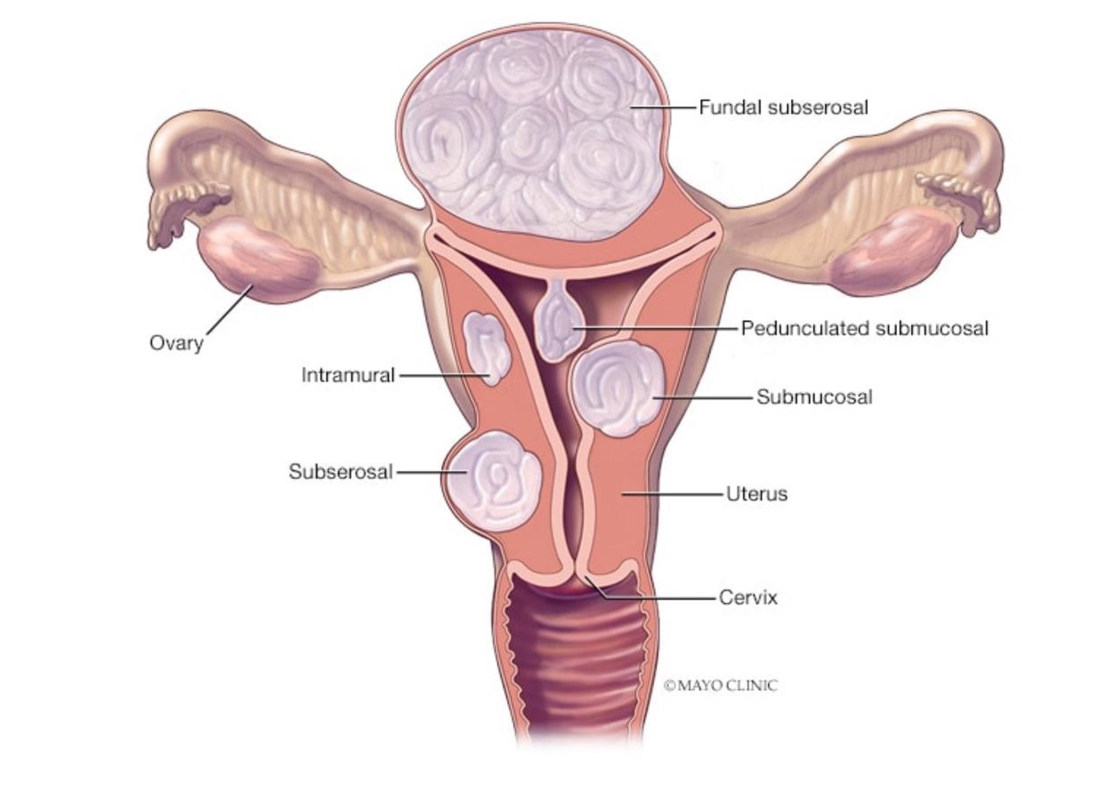 Fibroids