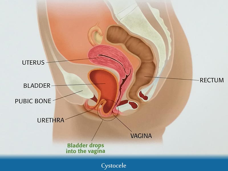 Cystocele