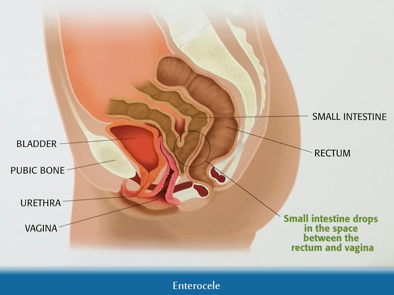 Enterocele